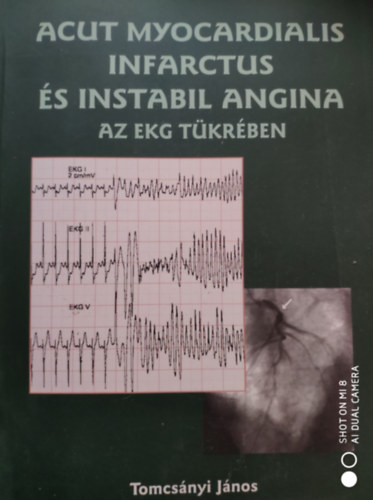 Tomcsnyi Jnos - Acut myocardialis infarctus s instabil angina az EKG tkrben